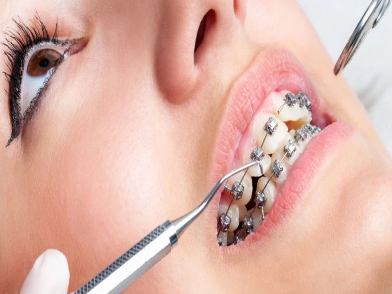 ارتودنسی دندان چیست؟ | انجام ارتودنسی دندان