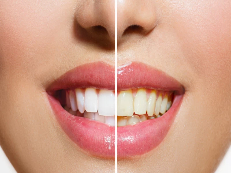 8 روش خانگی سفید کردن دندان | براق شدن دندان